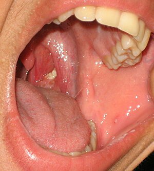 How to Remove Tonsil Stones You Can't See