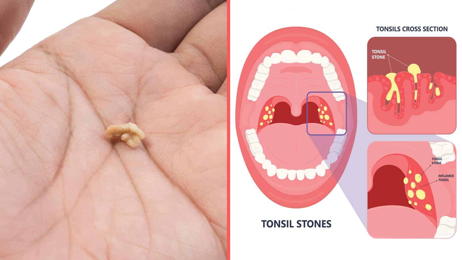 Tonsil stones pictures removal